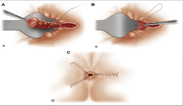 Effective Internal Hemorrhoid Treatment What You Need to Know